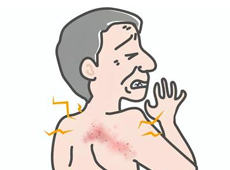帯状疱疹と帯状疱疹後神経痛